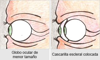 Prótesis oculares