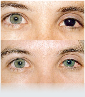 Prótesis Oculares