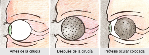 Prótesis oculares